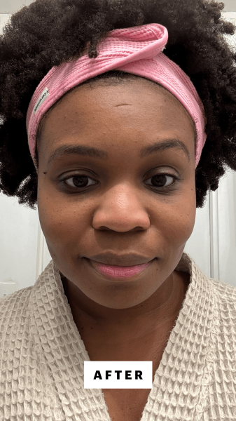 Cruel after applying the Shani Darden Triple Acid Signature Peel